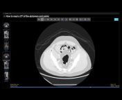 Learn Abdominal Radiology