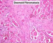 This is a webinar about the pathology of soft tissue sarcomas, including desmoid tumors. DTs are discussed first in this video (beginning at 5:13).nn5:13- 15:09 Desmoid fibromatosisn15:10- 22:37 Solitary fibrous tumorn22:47- 27:11 Low-grade fibromyxoid sarcoman27:21- 37:24 Leiomyosarcoman37:34- 40:16 Fibrosarcoman40:20- 47:56 Synovial sarcoman48:01- 56:06 Malignant peripheral nerve sheath tumor (MPNST)nn**Please note that this video is no longer CME accredited.