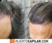 Paciente de 41 años, NW III Vertex,sin tratamiento médico. Donante normal, con pelo de 51 micras y 2,41 pelos /UF. Se ofrece estrategiaal mejor resultado en 1 cirugía para restaurar frontal y zona media, y posteriormente ver si necesita retoque. Se recomiendó finasteride 3 x semana voluntario, para estabilizar su coronilla. nZona donante con las siguientes características:n- Temporal: 50 μm de pelo; 78 UF/cm2; 170pelos/cm2; 2,18 pelos/UF; CV de 8,50 nn- Parietal: 51 μm de pelo; 84 UF/