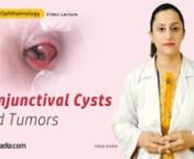 Learn about ‘Conjunctival Cysts and Tumors’ in this sqadia.com ophthalmology video lecture. All the important concepts regarding this topic are covered in this V-Learning™. From talking about the cysts of conjunctiva and non-pigmented tumors to pigmented and congenital tumors, every detail has been delineated. Additionally, malignant tumors and ocular surface squamous Neoplasia are comprehensively described.nn-------------------------------------------------------------nWatch complete lect