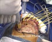 Craniotomia Fronto Parietal- Tumores e Aneurismas.avi from fronto