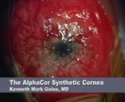 Traditional Large Incision technique in a 27-year-old Caucasian male with monocular vision and sclerocornea. He has had a prior pars planar vitrectomy, seton placement, keratolimbal stem cell allograph, and two failed penetrating keratoplasties prior to AlphaCor placement.nnVideo 1 in The Evolution of Surgical Approaches to AlphaCor Keratoprosthesis Insertion and Associated Complications. EyeRounds.org. September 13, 2006; Available from: http://www.eyerounds.org/cases/60-AlphaCor-Surgical-Appro