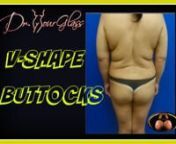The V-shaped buttocknnBefore surgery, it is extremely important to have a physical examination to determine the type of buttocks you have. There are different types of buttocks, and one of the most challenging ones to correct with any buttock enhancement procedure is the V-shaped buttock. nnWhat is a V-shaped buttock? The patient with a V-shaped buttock has a very small width at the lowest part of the butt compared to the top of the buttock. In essence, it creates a V. nnThese patients have the