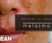 WHAT IS MELASMA ?nMelasma is a very common patchy brown, tan, or blue-gray facial skin discoloration, usually seen in women in the reproductive years. It typically appears on the upper cheeks, upper lip, forehead, and chin of women 20-50 years of age. It is uncommon in males. It is thought to be primarily related to external sun exposure, external hormones like birth control pills, and internal hormonal changes as seen in pregnancy. nnMost people with melasma have a history of daily or intermitt
