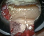 Lumbar spine dura suture on a Realists RealSpine Herniated Disc L4/L5 model by Prof. Dr. Enrico Tessitore, Deputy Head of Department in Neurosurgery. University Hospital of Geneva, Switzerland.