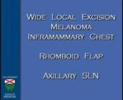 Dr Stephan Ariyan - Chest Melanoma-WLE , Rhomboid Flap, Axillary SLN- 17min- 2008 from ariyan