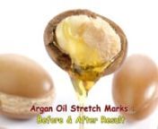 Finally A treatment For Stretch Marks by ARGANLife pure ARGAN OilnnDon&#39;t forget to subscribe us; https://www.youtube.com/user/arganlifehairgrowthnn♥ We are waiting for your feedback in comments. ♥n♥ ThanksnnnAs you know Argan Oil is a remarkable anti-aging product. Argan Oil allows with the collagen manufacturingand is impressive to get an elastic pores and skin. Argan Oil is likewise rich with antioxidants, omega, and diet E. Nutrition E is the paranormal component to help your pores and