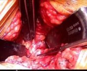 Live surgery 2018 - Anterior Lumbar Interbody Fusion - ALIF - Pr Olivier Gille from alif