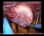 colon surgery - Laparoscopic - anastomosis from get plastic surgery for free