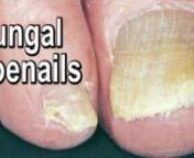 Toenail Fungus – Podiatry Fleming Island and Palm Beach FloridanDr. Jimmy Militello discusses the symptoms, causes and treatments for toenail fungus. - Podiatrist in St. Augustine, FLn www.healthparkdocs.comnFungal nails refers to any number of fungal nail infections that can occur on the foot. Since fungal nails are usually more resistant and more difficult to treat than Athlete&#39;s Foot, topical or oral antifungal medications may be prescribed. Note: Please consult a physician before taking an