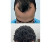 Hair transplant involves a surgical process where hair follicles are taken from a healthy area on the head, often the back or sides called the ‘donor area,’ and transplanted into the balding area of the head, known as the ‘recipient site.’ This technique is effective for addressing male pattern baldness or receding hairlines in women. Hair transplants can also restore hair in the beard and eyebrows.nnCauses of Hair LossnThe common causes of hair loss are:nnNeglecting regular scalp massag