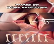 Common Types Of Bone Fracture 3D Animation&#60;br/&#62;#bonefracture #bonefracturetypes #fracture #bonefracture #bonefractures #transversefracture #compundfracture #obliquefracture #openfracture #femurfracture #thighfracture