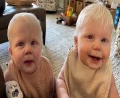 Credit: SWNS / Alex Burnham&#60;br/&#62;&#60;br/&#62;A mum whose twin daughters were born with albinism said people &#92;
