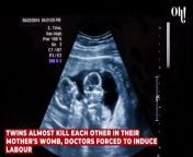 Twins almost kill each other in their mother's womb, doctors forced to induce labour from labour party